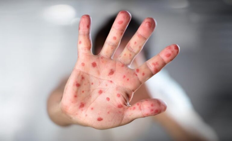 Chile emitió una alerta epidemiológica por el aumento de sarampión en Argentina